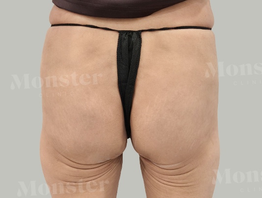 엉덩이필러 시술전
